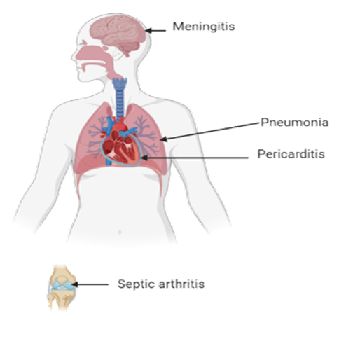 Image illustrant les signes cliniques de la maladie méningococciques