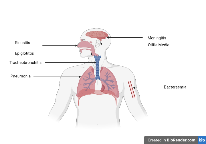 Image des caractéristiques cliniques de [i]Haemophilus influenzae[/i] sur les organes ou parties du corps affectés organs or body parts 